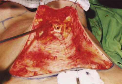 9 In 1992, Illouz 10 published a technique of abdominoplasty without undermining that was used in obese patients with pendulous abdomens or for supraumbilical abdominoplasties, in which an en bloc