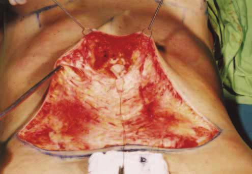 Figure 5. omplementary lipoplasty is performed to remove the fat excess. Figure 6.