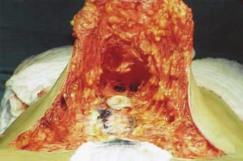 Figure 7. Rectus abdominis muscle plication.