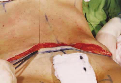 the cross-shaped incision.