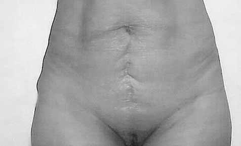 Figure 11.,, Preoperative views of a 39-year-old woman., D, Postoperative views 6 months after lipoabdominoplasty.