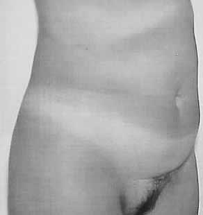 abdominal profile because it enables ample traction of the superior abdominal regions (Figures 6 to 9).