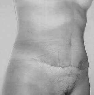 aesthetic scars. We believe that it is a safer way to treat the abdominal region than classical abdominoplasty and that it produces more harmonious results with fewer complications. References 1.