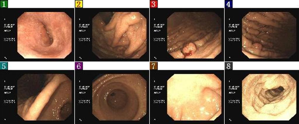 Page 2 of 6 Translational Gastroenterology and Hepatology, 2016 Figure 1 On May 12, 2015, gastroscopy revealed a 1.2-cm polypoid uplift in the greater curvature of the middle part of gastric body.