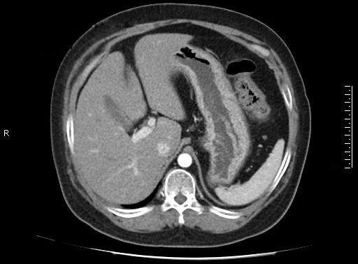 Translational Gastroenterology and Hepatology, 2016 Page 3 of 6 A B C D Figure 2 On May 11, 2015, abdominal contrast-enhanced CT showed: the wall of gastric body became swollen; a nodule sized 0.