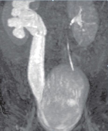 2 Case Reports in Urology Figure 1: On the coronal MR urography image, the right ureter and the pelvicalyceal system are seen dilated.