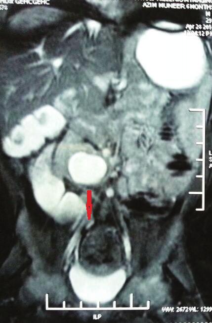 MRU showed upperureteric dilatation and PCS of left crossed renal moiety. On exploration, a ureteric stricture of crossed renal moiety was diagnosed and the subjected ureter was reimplanted. 2.5.