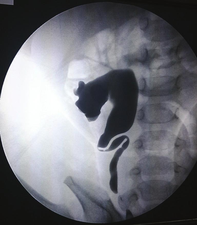 4 Case Reports in Urology Figure 4: Retrograde pyelography demonstrating a midureteric stricture and proximal dilated ureter.