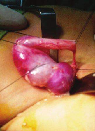 Discussion Figure 5: Photograph showing dilated ureter proximal to the stricture and distal normal caliber ureter. showed the site and length of the stricture.