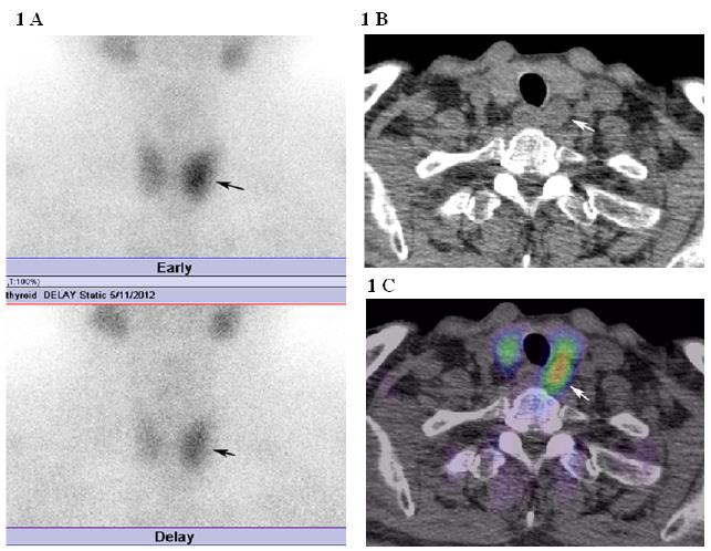 Monzen Y et al SPECT/CT Fusion of Hyperparathyroidism level increased after the surgery in 1 patient with PHPT.