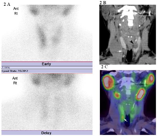 SPECT/CT Fusion of Hyperparathyroidism Monzen Y et al The mean size of the detected and undetected parathyroid adenomas in planar scintigraphy was 1.3±0.6 and 1.1±0.1 cm, respectively (P=0.7).