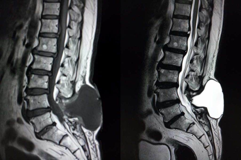 Sagittal MRI image showing sac arising from L4-5