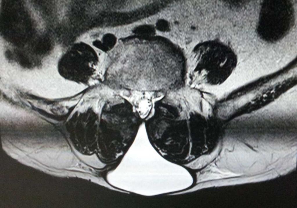 Image 3: Axial MRI image showing sac