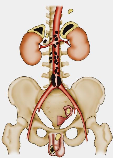Glandula suprarenalis (suprarenal gland, adrenal gland) paired gland situated at upper pole of