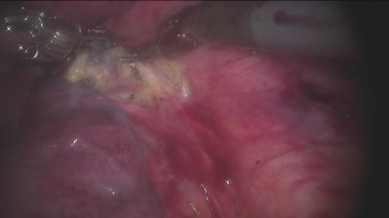 Figure 18 The lung was filled with water and checked for