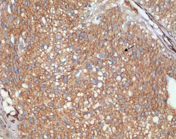 Figure 1. The immunohistochemical staining of Shh protein in the GIST tumor cell cytoplasm and on the cell membrane (200 magnification). Figure 3.