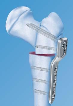 Diaphysen (CCD) angle: 127 0 mm, 140 and 150 Ideal for valgus