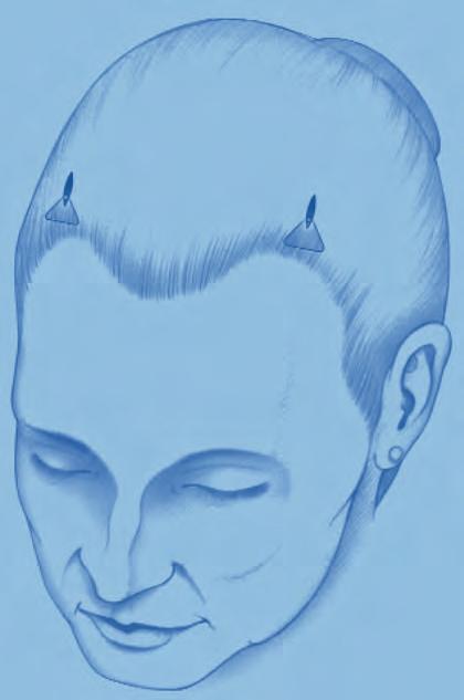 Endoscopic Forehead Lift Procedure 1 MAKE THE INCISION Make a sagittal, paramedian