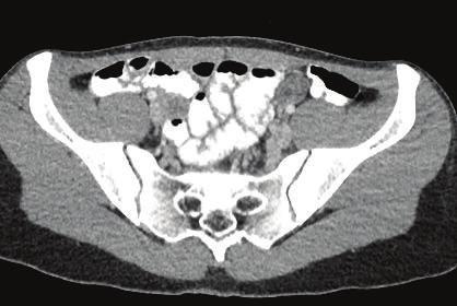 Axial CT image shows both the right