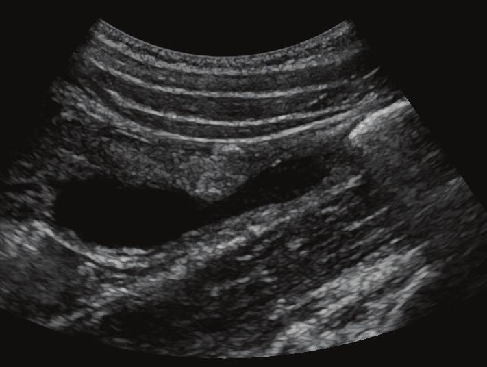 sonographic image of the right upper