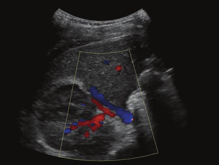 with no internal flow on color Doppler.