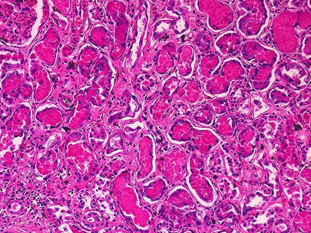 In renal cortical necrosis, the entire cortex may be affected or the lesion may be patchy. When the lesions are patchy, they tend to resemble infarcts.