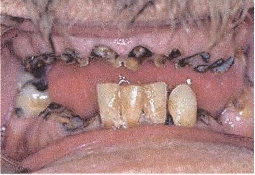 If usage progresses, several long-term effects are possible: Lowered resistance to all types of diseases and aliments Rotten teeth, often referred to as Meth Mouth Mood instability (extreme highs to
