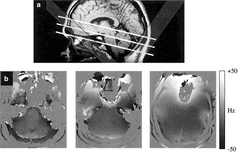 700 Jacobs et al. FIG. 1. a: Slice locations for proton MRSI of the cerebellum and brain stem, overlaid on midsagittal T 1 -weighted localizer image.