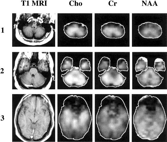 Proton MRSI of the Cerebellum 701 FIG. 2. T 1 -weighted and metabolic images (Cho, Cr, and NAA) from the three slice locations indicated in Fig. 1. Particularly apparent are the high levels of Cho and Cr in slice 2, corresponding to the cerebellar hemispheres and vermis.