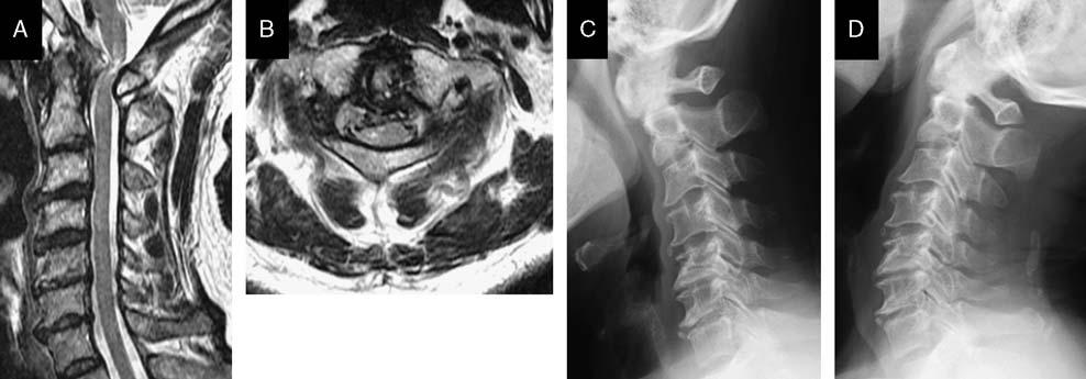 A surgical microscope and intraoperative monitoring was used. A midline skin incision was applied at C1 C2. After C1 lamina exposure (Fig. 3A), a C1 laminectomy was performed using a diamond burr.