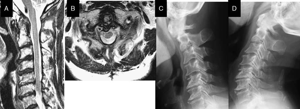 Fujiwara et al J Spinal Disord Tech Volume 28, Number 10, December 2015 FIGURE 6. The final follow-up images. A and B, Final follow-up magnetic resonance imaging.
