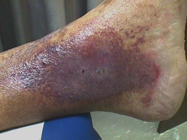 Photo: Venous wound with