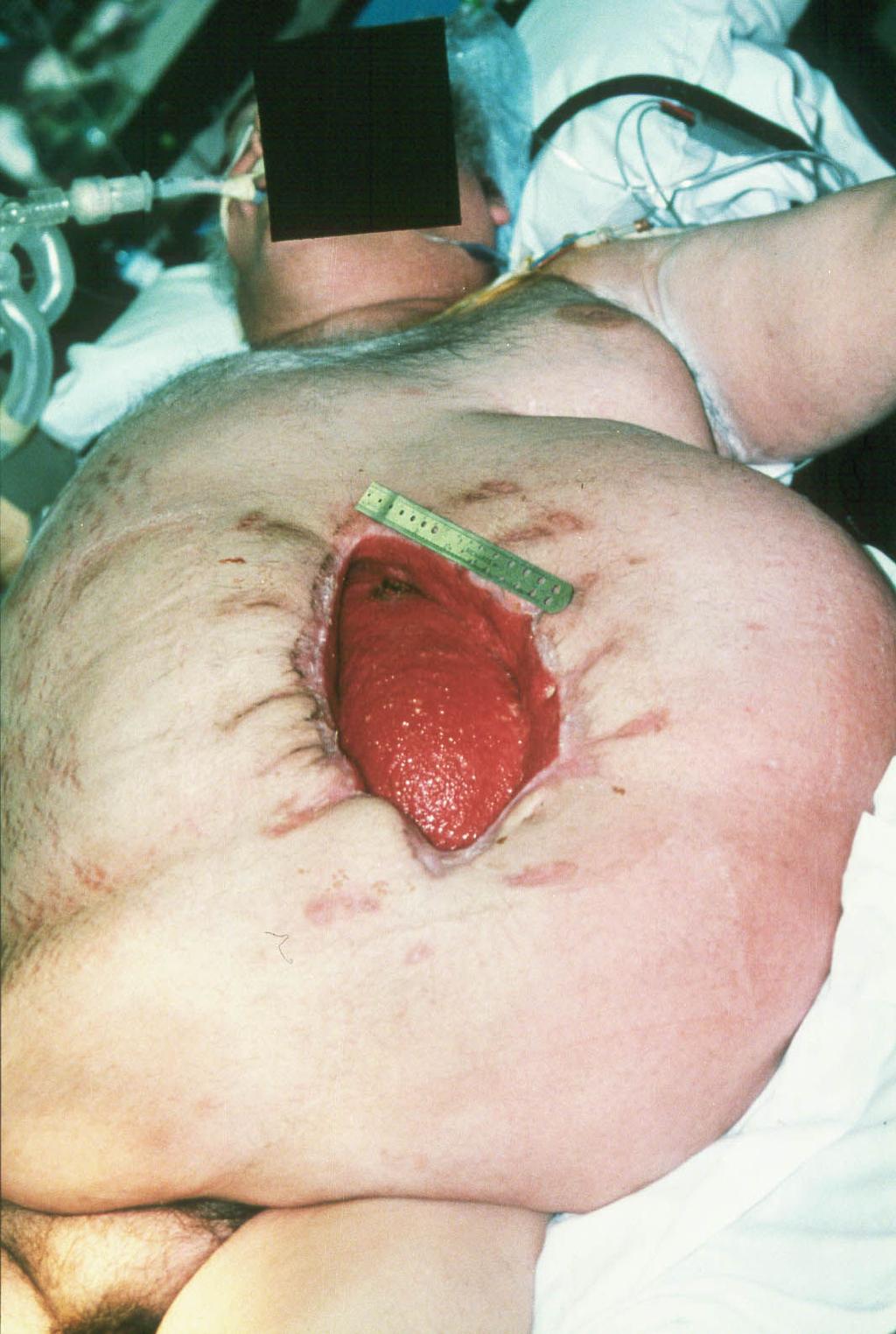 Photo: Dehisced Surgical Incision Past Medical History What is your patient s medical history and how does it relate to their current condition? Are they diabetic? Is there a surgical history?