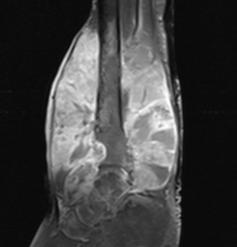 involvement was noted in 6 cases on MRI.