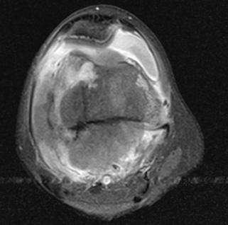 21 yr boy T2W1 involving the left iliac bone with sunburst periosteal reaction 3. Results Age of the patients included in the study ranged from 10 to 70 years.