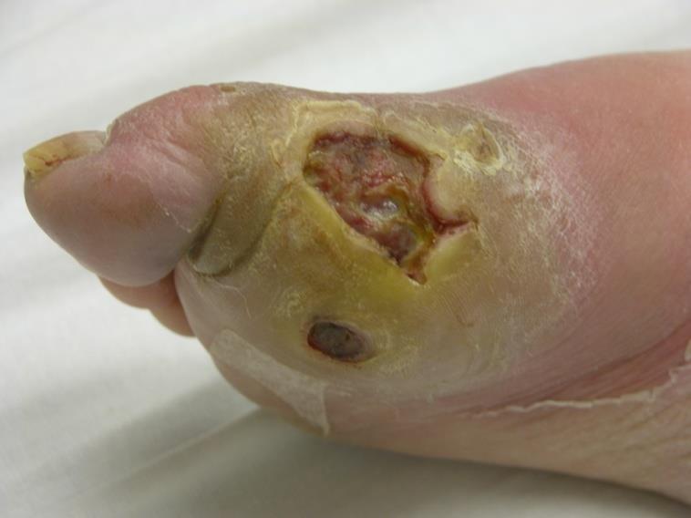 Diabetes Related Major Lower Extremity Complications Ulceration Infection Lower extremity amputation Charcot foot (Osteoarthropathy)