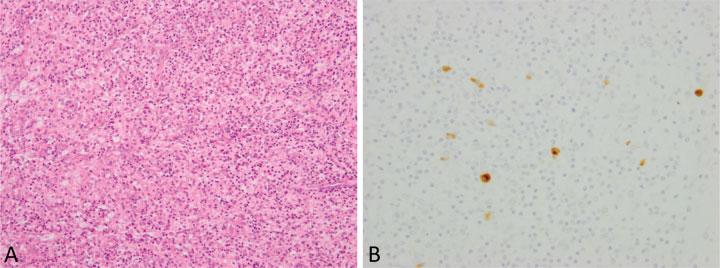 Pathology of IgG4-Related Disease in the Bile Duct and Pancreas Zen 251 Fig. 10 Liver biopsy findings of primary sclerosing cholangitis. (A) There is periductal concentric fibrosis.