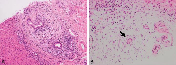 Histologically, the non-igg4-related fibrohistiocytic type is characterized by an extensive xanthogranulomatous reaction.