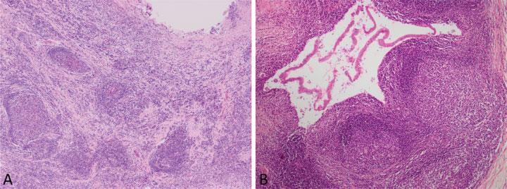 252 Pathology of IgG4-Related Disease in the Bile Duct and Pancreas Zen Fig. 12 Follicular cholangitis.