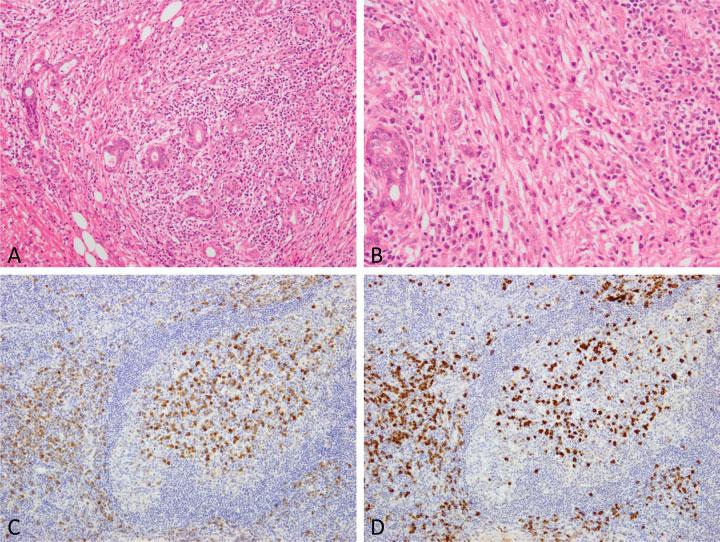 Pathology of IgG4-Related Disease in the Bile Duct and Pancreas Zen 243 Fig. 1 Histological features of immunoglobulin G4-related disease (IgG4-RD) in salivary and lacrimal glands.