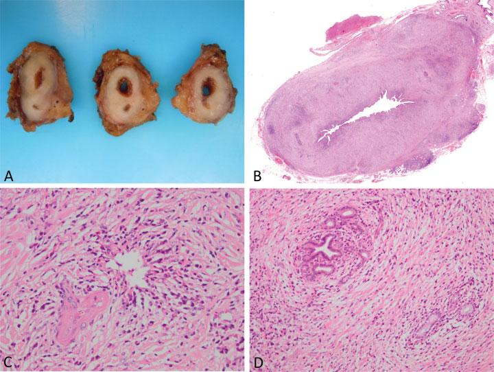 Pathology of IgG4-Related Disease in the Bile Duct and Pancreas Zen 245 This may have been because many patients with AIP were not included; their diagnoses were established without tissue