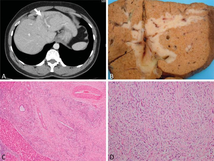 Pathology of IgG4-Related Disease in the Bile Duct and Pancreas Zen 247 Fig. 5 An Immunoglobulin G4-related hepatic inflammatory pseudotumor.