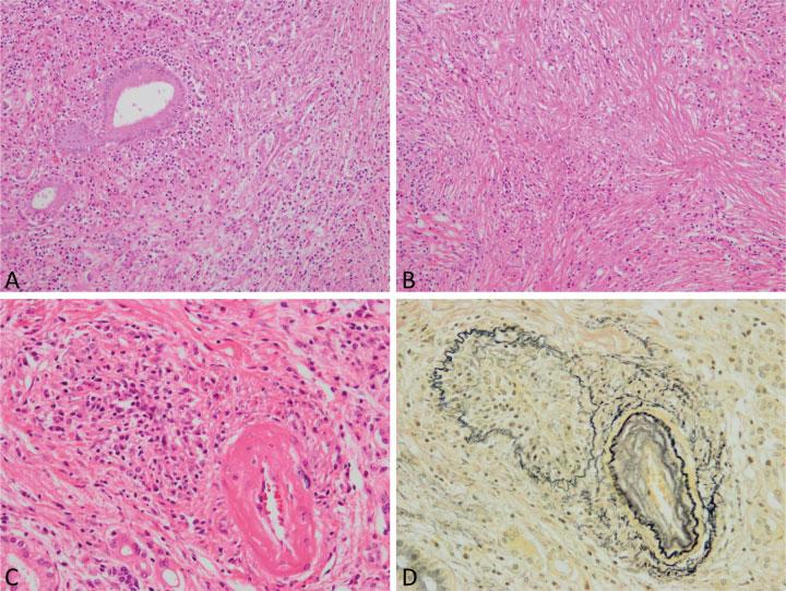 248 Pathology of IgG4-Related Disease in the Bile Duct and Pancreas Zen Fig. 6 Immunoglobulin G4-related autoimmune pancreatitis.
