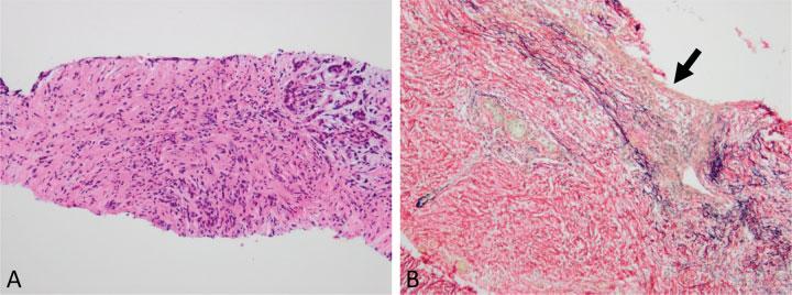 Pathology of IgG4-Related Disease in the Bile Duct and Pancreas Zen 249 Fig. 7 Liver biopsy findings of immunoglobulin G4- (IgG4-) related sclerosing cholangitis.