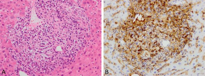 diagnosis of IgG4-SC when a large piece of tissue is obtained. Obliterative phlebitis and storiform fibrosis are not observed in superficial biopsies.