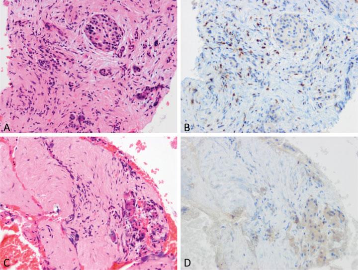 250 Pathology of IgG4-Related Disease in the Bile Duct and Pancreas Zen Fig. 9 Pancreatic biopsy after steroid therapy for immunoglobulin G4-related autoimmune pancreatitis.