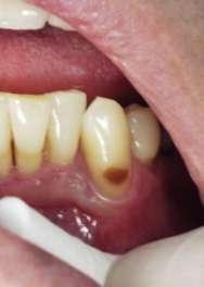 research in dental care ozone treatment of root caries objectives of this study: Holmes J. Clinical reversal of root caries using ozone, double-blind, randomised, controlled 18- month trial.