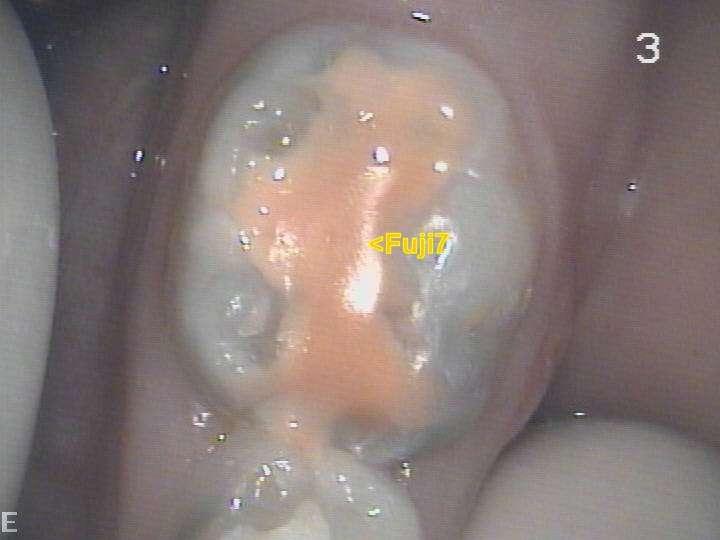 primary teeth example 10 jade,