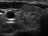 Natural Course of Benign Thyroid Nodules calcification (n=8, 4.0%) and macrocalcification (n=25, 12.4%) initially existed in a substantial portion of benign nodules.