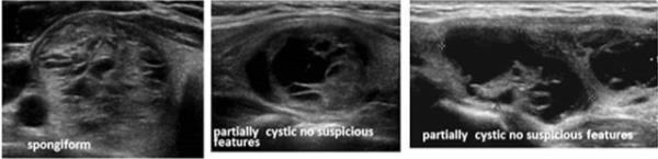 Very low suspicion >50% multiple microcysts Cysts that are not meet criteria for high, intermediate or low suspicion From 2015 American